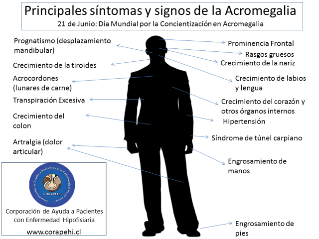 principales síntomas de la Acromegalia - Chile